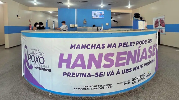 Dia da Mancha: Governo do Amapá promove ação de acolhimento e teste de sensibilidade para detectar a hanseníase